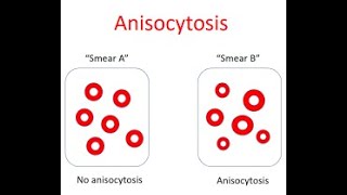 Anisocytosis  Symptoms and Causes  Diagnosis  Treatment  Prevention [upl. by Aeirdna]