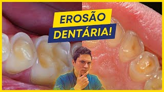 COMO TRATAR A EROSÃO DENTÁRIA [upl. by Etteiluj]