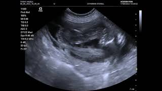 Canine Pregnancy Scan using the Siemens Acuson P500 [upl. by Sivaj257]