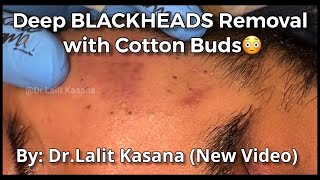 Deep Blackheads Removal with Cotton Buds by DrLalit Kasana [upl. by La594]