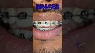 Black modules Braces [upl. by Cazzie503]