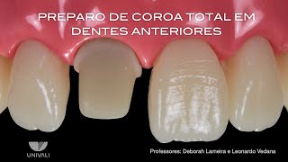 Coroa total dentes anteriores [upl. by Jeramey]