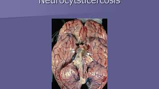 Neurocysticercosis neuroscience module [upl. by Notloc110]