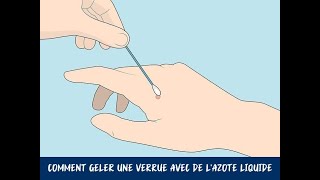 Comment geler une verrue avec de lazote liquide [upl. by Jobie564]