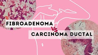 Fibroadenoma versus carcinoma ductal [upl. by Zoellick]