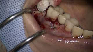 Straumann TLX placement in posterior maxilla TYPE II 3 [upl. by Ziegler]