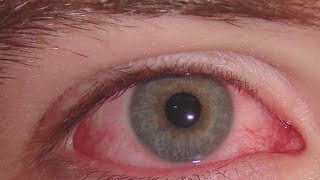 ¿Qué es cuáles son sus síntomas y cómo prevenir la conjuntivitis [upl. by Adnilrev]