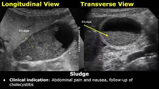 Gallbladder Ultrasound Reporting  GB Disease Scan Reports  How To Write USG Report  Abdominal USG [upl. by Anelram]