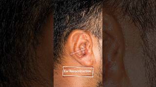 Before and After Results of Ear Reconstruction  Best Plastic Surgeon in Mumbai  drparagtelang [upl. by Earleen]