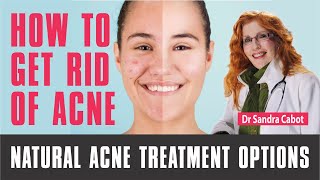 How to get rid of Acne Forever  Acne treatment Options acne acnetreatment [upl. by Lita]