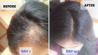 OMG  15 Days Hair Growth Miracle Treatment  Grow Long Thicken Hair  100 works [upl. by Anaeco]