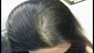 Hair Back for hair loss review  االعلاج الجذري لتساقط الشعر و الصلع [upl. by Okechuku]