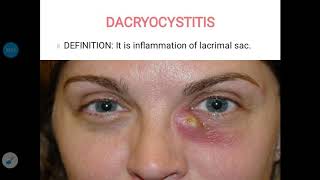 Dacryocystitis [upl. by Luci]