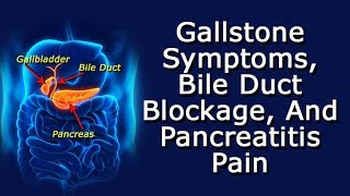 Gallstone Symptoms Bile Duct Blockage And Pancreatitis Pain [upl. by Arita]