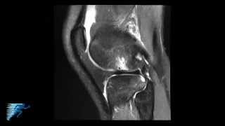 How to Read Knee MRI of ACL Tear  Anterior Cruciate Ligament Pain  Knee Surgery  Minneapolis MN [upl. by Pris]