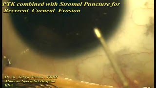 PTK with stromal Puncture for RCE [upl. by Eisle]