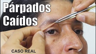 CIRUGIA de PARPADOS SUPERIORES 👀 Párpados caídos 🙌 BLEFAROPLASTÍA Superior ❤️ DR PERCY NEVADO [upl. by Buonomo]