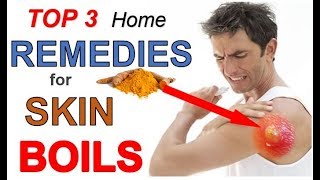 Top 3 Home Remedies for Skin Boils THAT WORK  How to Get Rid of Skin Boils in 3 Easy Steps [upl. by Leemaj]