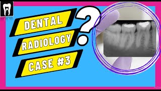 Dental Radiology Case3 Radiographic Interpretation DENTAL CASE DISCUSSION Facial space infection [upl. by Leina200]