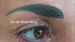 Permanent Makeup Entfernung der Augenbrauen [upl. by Esirehc]