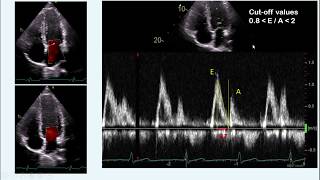 diastolic dysfunction part I  concept amp measurement [upl. by Osher]