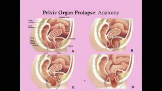 Pelvic Organ Prolapse  CRASH Medical Review Series [upl. by Sybyl297]