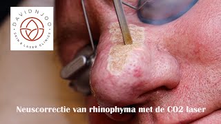 Neuscorrectie van rhinophyma met de CO2 laser [upl. by Shelton859]