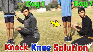 Knock knee कैसे ठीक करें  Knock knee problem solution  knock knees best exercise and tips in hindi [upl. by Sophey729]