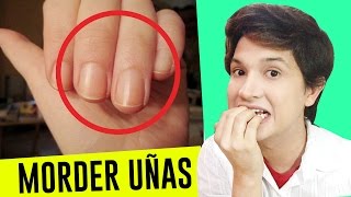 COMO DEJAR DE COMERSE LAS UÑAS  REMEDIOS CASEROS  ONICOFAGIA TRATAMIENTO  AndyZaturno [upl. by Weidman]