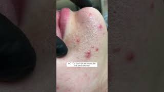 Best Pimple Pop Videos Blackheads Acne Cyst Popping Ingrown Hair Removal [upl. by Lathrop]