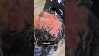 Sensitive Scalp Transformation 😱 [upl. by Ylek]