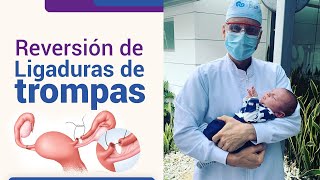 Reversión de la ligadura de trompas l Dr Juan Luis Giraldo [upl. by Eikceb502]