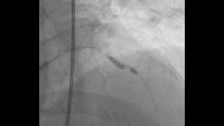 balloon undilatable coronary lesion role of rotatripsy [upl. by Alur810]