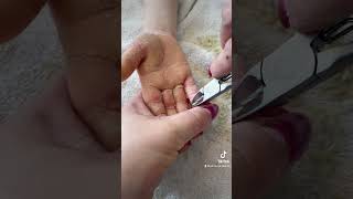 Removing callus from kid hands  Keratoderma hyperkeratosis EPPK skin shaving callous  Mar 30 2023 [upl. by Lily]