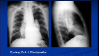 Chest xray interpretation Sarcoidosis [upl. by Renick873]