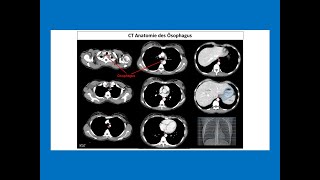 CT Anatomie vom Ösophagus  Strahlentherapie Prof Hilke Vorwerk [upl. by Yelloh]