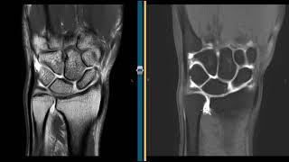 Two common wrist injuries seen on MRI [upl. by Suedaht]