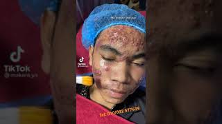 Acne peeling [upl. by Sukul]