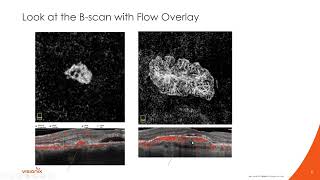 OCT Angiography Age Related Macular Degeneration with Dr Julie Rodman [upl. by Tiga]