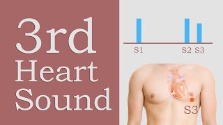 3rd Heart Sound S3 [upl. by Nodnarbal369]