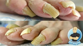 LONG TOENAILS FOR DAYS  TOENAIL CUTTING PART 1 [upl. by Bruning708]