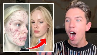 Reacting to MindBlowing Skin Transformations😱 [upl. by Portingale105]