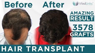 Hair Transplant in Grade 4 Baldness  Perfecti Hair transplant 3578 Grafts Implanted  Medlinks [upl. by Annayi]