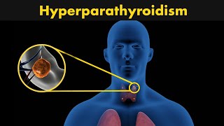 How hyperparathyroidism occurs  DiagnosisTreatment and symptoms of hyperparathyroidism [upl. by Giacinta520]