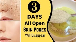 3 Days and All Open Pores Will Disappear from Your Skin Forever [upl. by Enilkcaj247]