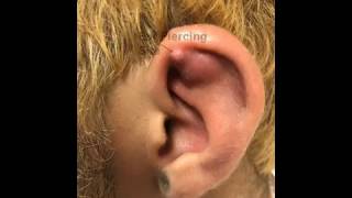 Left Ear Helix Abscess Chondritis or Not [upl. by Atiana802]