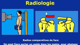 traumatologie Fractures de la clavicule [upl. by Annabela341]