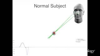 A new saccadic indicator of peripheral vestibular function based on the video head impulse test [upl. by Lahcsap]