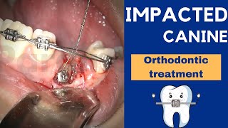 IMPACTED CANINE exposure treatment with ORTHODONTICS and braces  Step by step [upl. by Byron93]