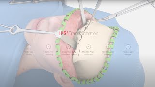 IPS® Transformation  Facial Feminization Surgery [upl. by Elspeth]